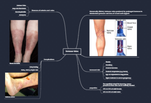 Varicose Veins