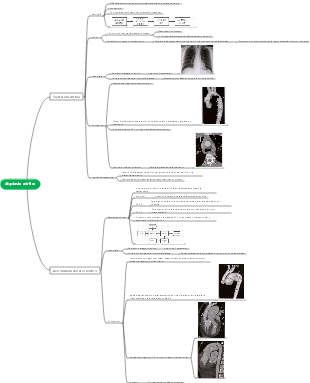 Mapa mental de displasia aórtica
