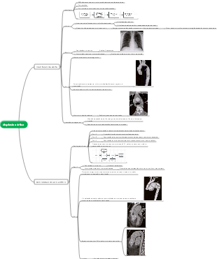 Mapa mental da displasia aórtica